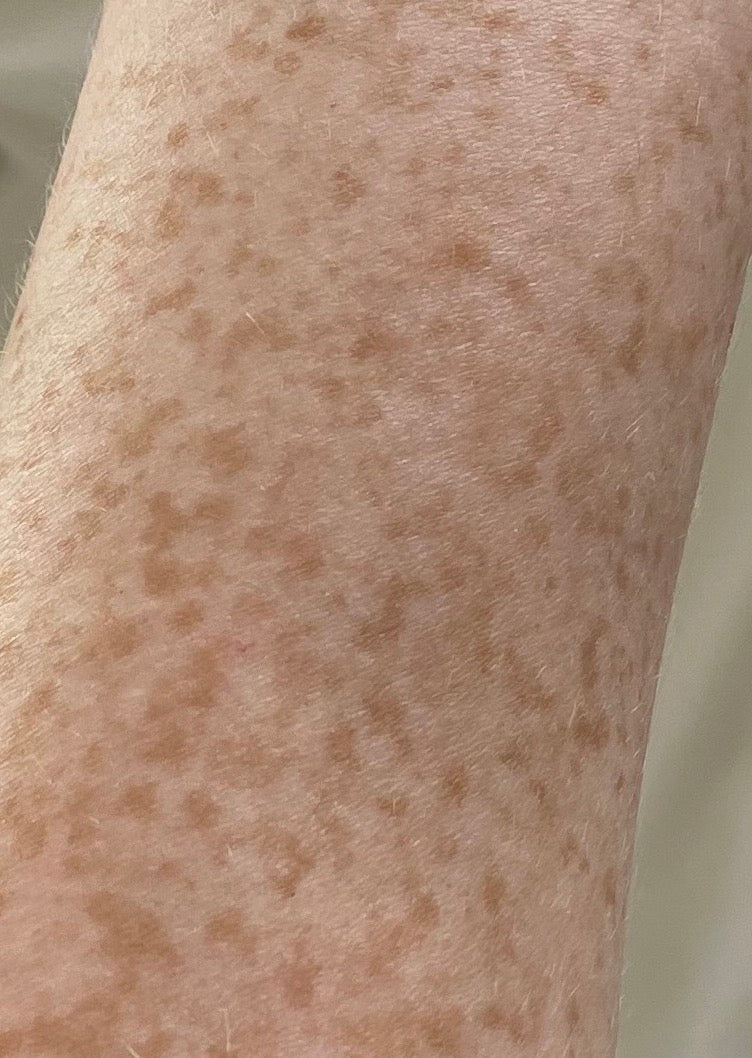 SCAR CONCENTRATE